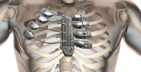 3d-printed ribcage implant