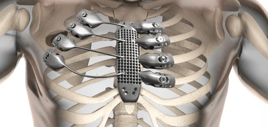 3d-printed ribcage implant